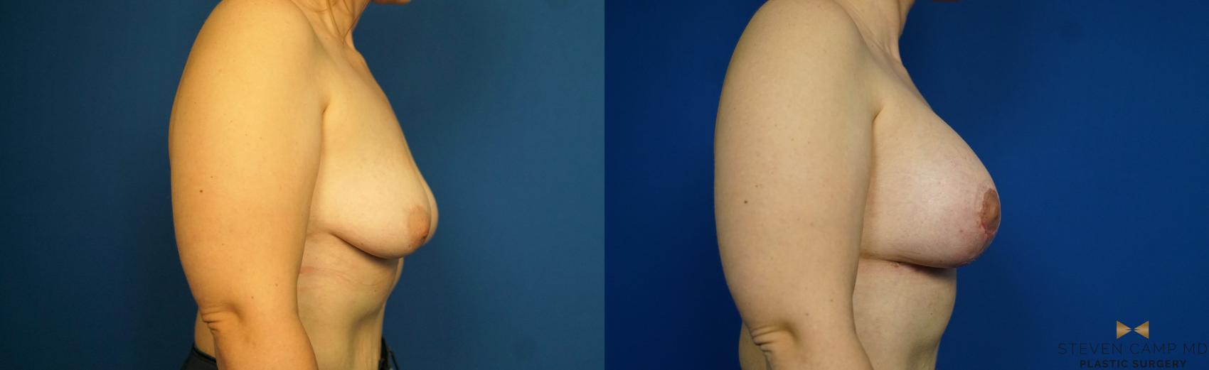 Before & After Breast Lift (Breast Mastopexy with Implants) Case 217 View #2 View in Fort Worth & Arlington, Texas