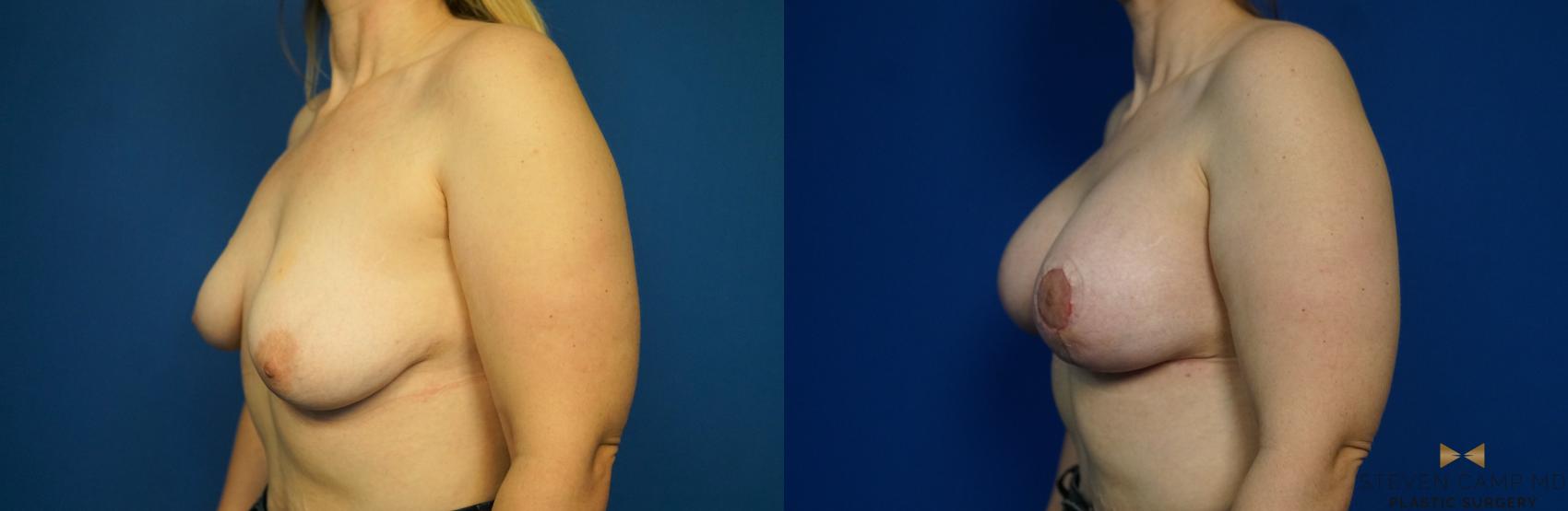 Before & After Breast Lift (Breast Mastopexy with Implants) Case 217 View #4 View in Fort Worth & Arlington, Texas