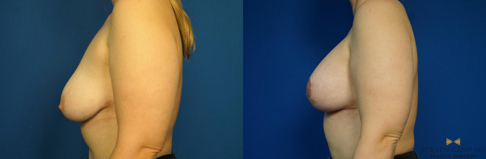 Before & After Breast Lift (Breast Mastopexy with Implants) Case 217 View #5 View in Fort Worth & Arlington, Texas