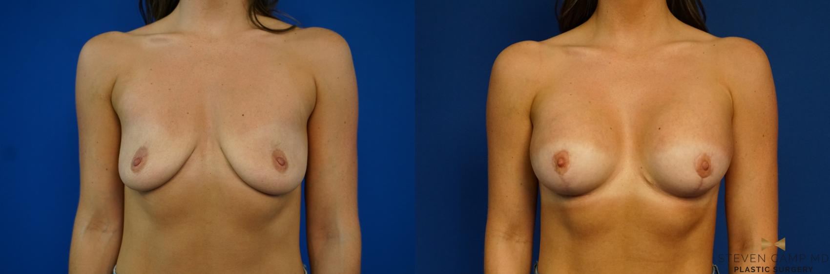 Before & After Breast Lift with or without Implants Case 218 View #1 View in Fort Worth, Texas