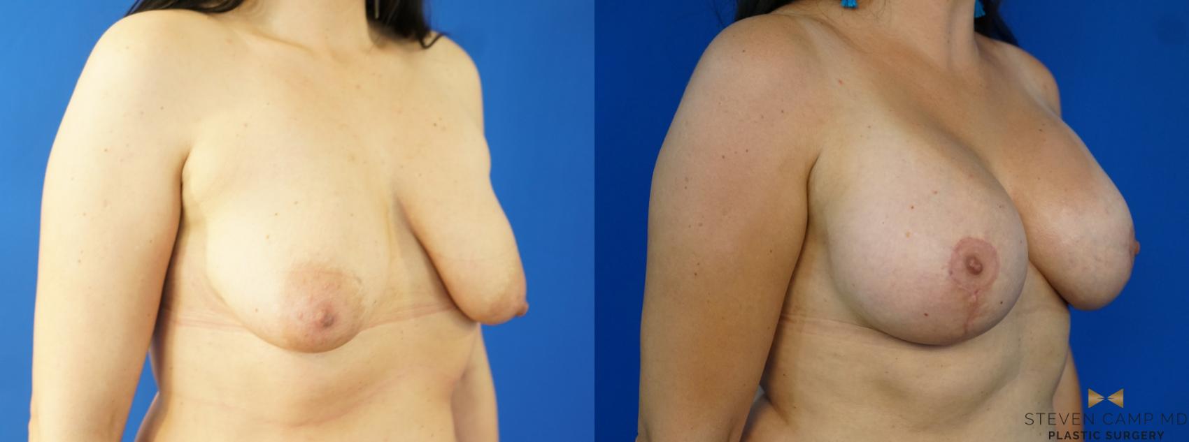 Before & After Breast Lift (Breast Mastopexy with Implants) Case 222 View #2 View in Fort Worth & Arlington, Texas