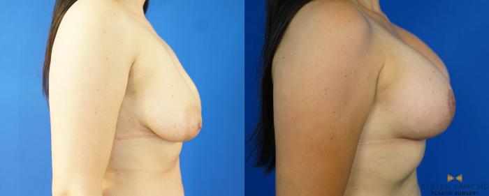 Before & After Breast Lift with or without Implants Case 222 View #3 View in Fort Worth, Texas