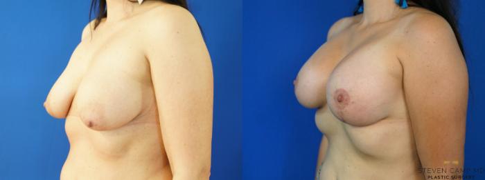 Before & After Breast Lift with or without Implants Case 222 View #4 View in Fort Worth, Texas