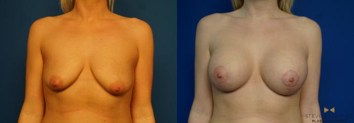 Before & After Breast Lift with or without Implants Case 320 Front View in Fort Worth, Texas