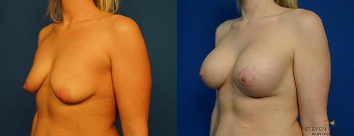 Before & After Breast Lift with or without Implants Case 320 Left Oblique View in Fort Worth, Texas
