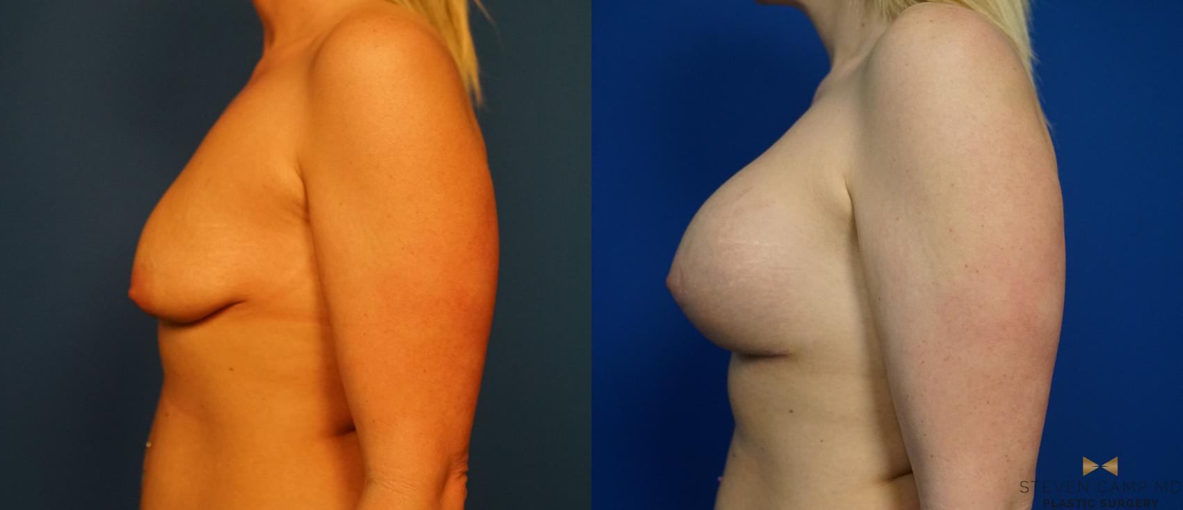Before & After Breast Lift with or without Implants Case 320 Left Side View in Fort Worth, Texas