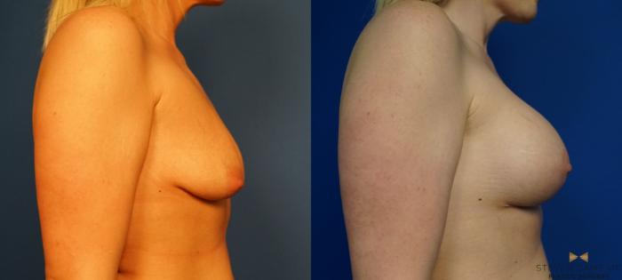 Before & After Breast Lift with or without Implants Case 320 Right Side View in Fort Worth, Texas