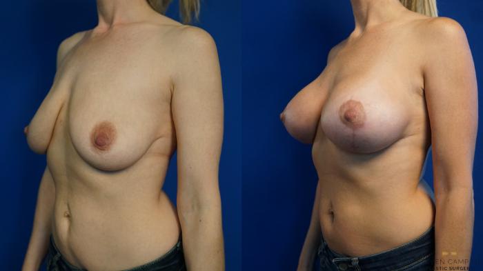Before & After Breast Lift (Breast Mastopexy with Implants) Case 326 Left Oblique View in Fort Worth & Arlington, Texas