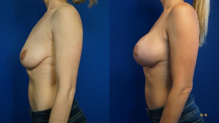 Before & After Breast Lift (Breast Mastopexy with Implants) Case 326 Left Side View in Fort Worth & Arlington, Texas