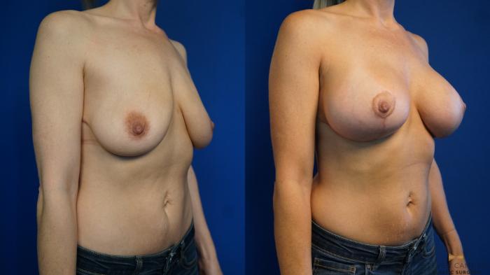 Before & After Breast Lift (Breast Mastopexy with Implants) Case 326 Right Oblique View in Fort Worth & Arlington, Texas