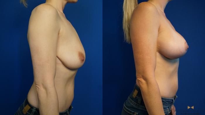 Before & After Breast Lift (Breast Mastopexy with Implants) Case 326 Right Side View in Fort Worth & Arlington, Texas