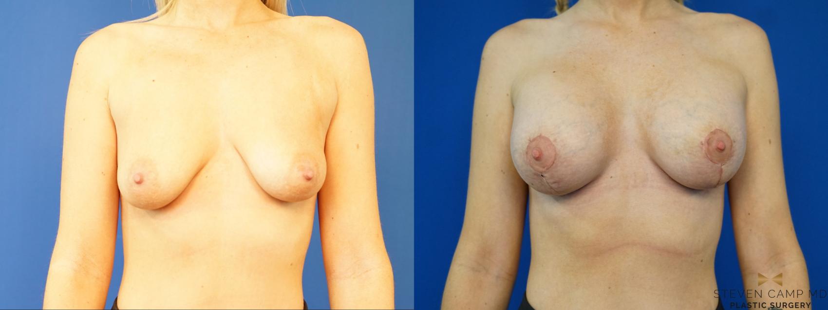 Before & After Breast Lift (Breast Mastopexy with Implants) Case 327 Front View in Fort Worth & Arlington, Texas