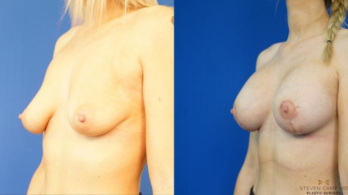 Before & After Breast Lift (Breast Mastopexy with Implants) Case 327 Left Oblique View in Fort Worth & Arlington, Texas