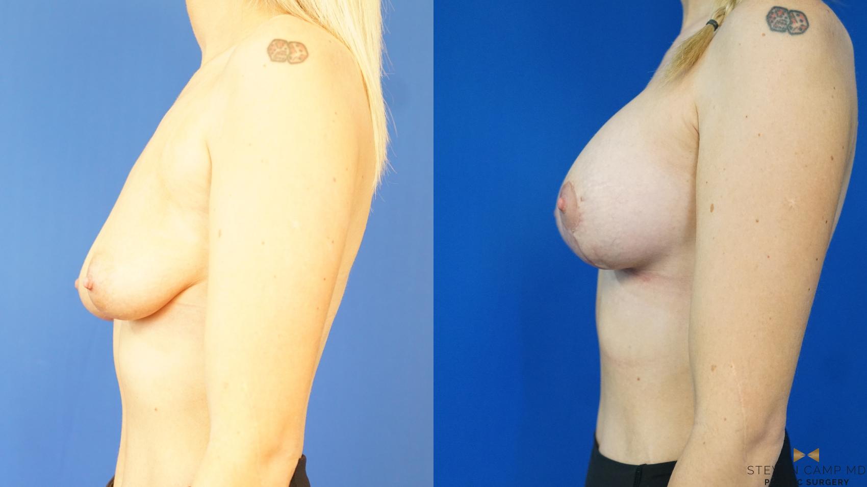 Before & After Breast Lift (Breast Mastopexy with Implants) Case 327 Left Side View in Fort Worth & Arlington, Texas