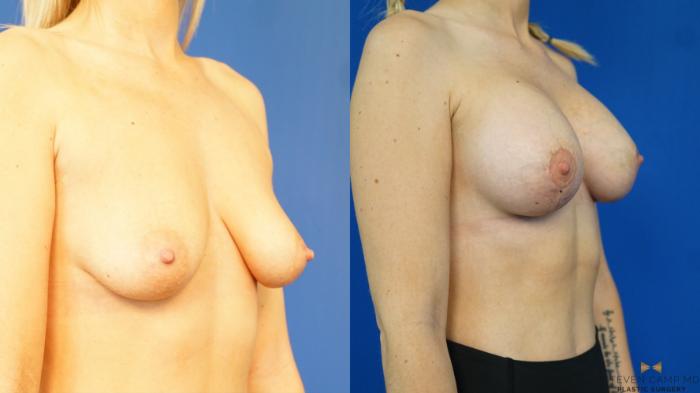 Before & After Breast Lift (Breast Mastopexy with Implants) Case 327 Right Oblique View in Fort Worth & Arlington, Texas