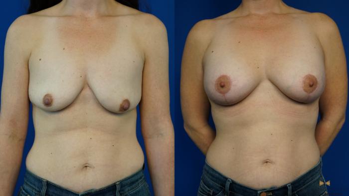 Before & After Breast Lift with or without Implants Case 341 Front View in Fort Worth, Texas
