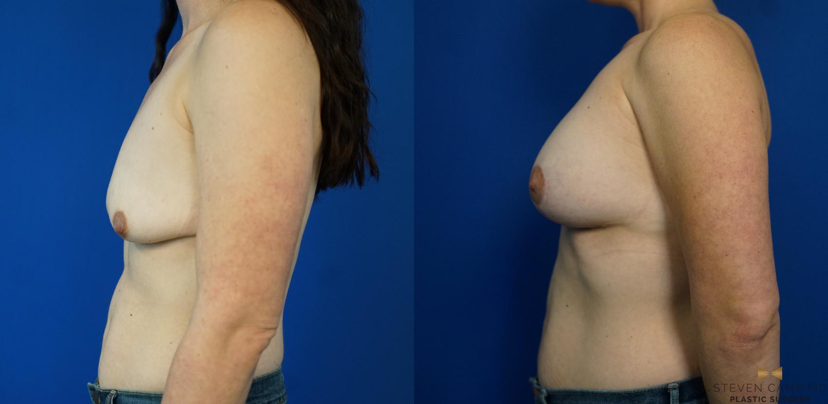 Before & After Breast Lift with or without Implants Case 341 Left Side View in Fort Worth, Texas