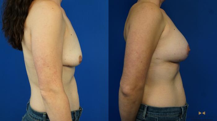 Before & After Breast Lift with or without Implants Case 341 Right Side View in Fort Worth, Texas