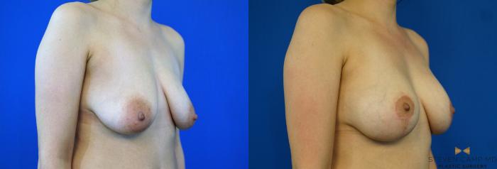 Before & After Breast Lift (Breast Mastopexy with Implants) Case 346 Right Oblique View in Fort Worth & Arlington, Texas