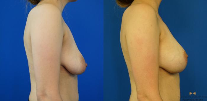 Before & After Breast Lift (Breast Mastopexy with Implants) Case 346 Right Side View in Fort Worth & Arlington, Texas