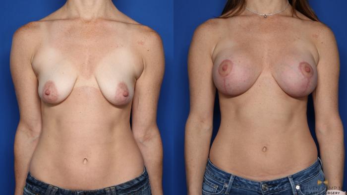 Before & After Breast Lift with or without Implants Case 348 Front View in Fort Worth, Texas