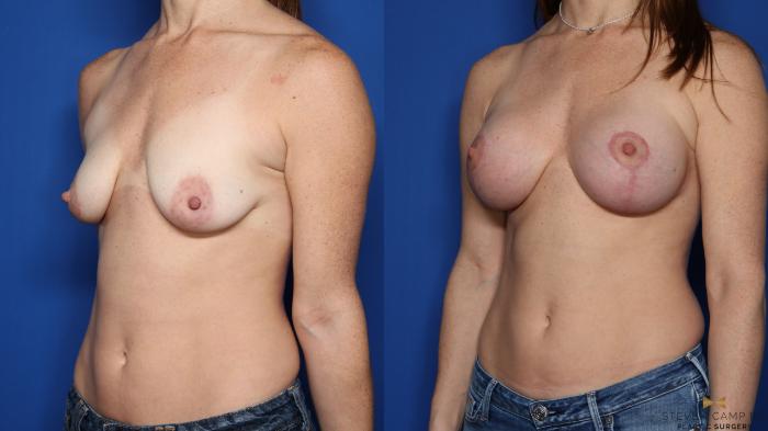 Before & After Breast Lift (Breast Mastopexy with Implants) Case 348 Left Oblique View in Fort Worth & Arlington, Texas