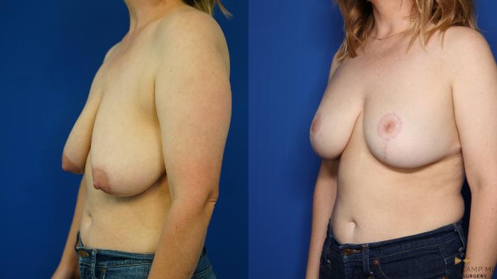 Before & After Breast Lift (Breast Mastopexy with Implants) Case 352 Left Oblique View in Fort Worth & Arlington, Texas