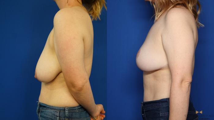 Before & After Breast Lift (Breast Mastopexy with Implants) Case 352 Left Side View in Fort Worth & Arlington, Texas