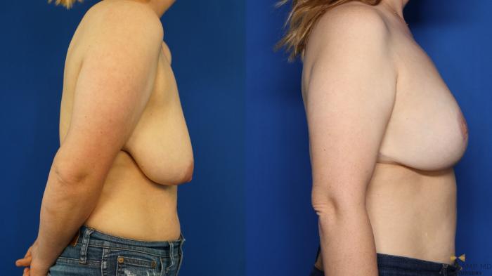 Before & After Breast Lift with or without Implants Case 352 Right Side View in Fort Worth, Texas