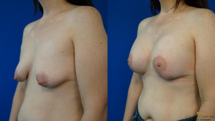 Before & After Breast Lift (Breast Mastopexy with Implants) Case 353 Left Oblique View in Fort Worth & Arlington, Texas