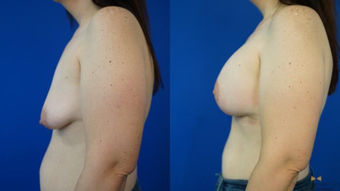 Before & After Breast Lift (Breast Mastopexy with Implants) Case 353 Left Side View in Fort Worth & Arlington, Texas