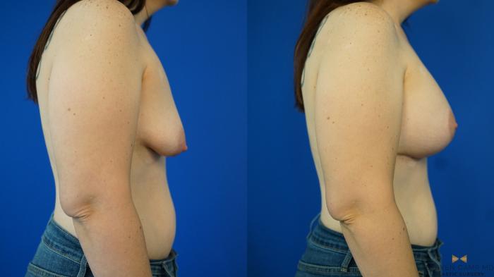 Before & After Breast Lift (Breast Mastopexy with Implants) Case 353 Right Side View in Fort Worth & Arlington, Texas