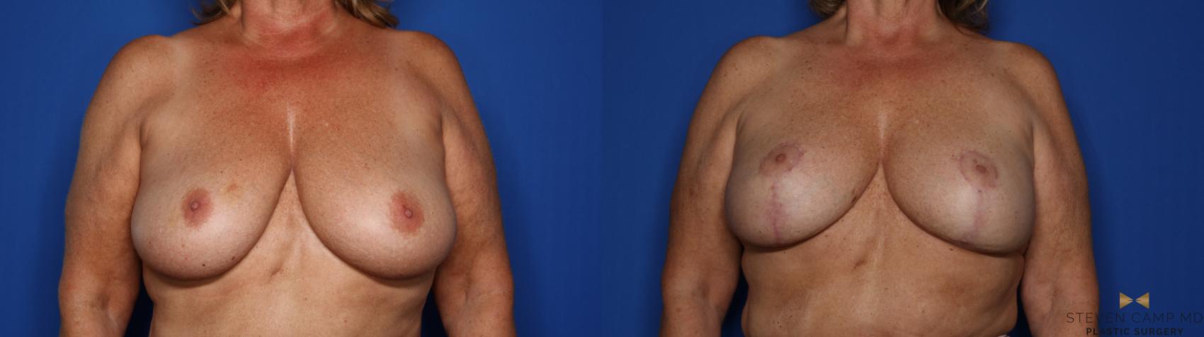 Before & After Breast Lift (Breast Mastopexy with Implants) Case 411 Front View in Fort Worth & Arlington, Texas