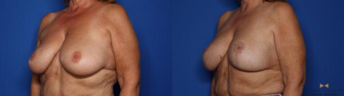 Before & After Breast Lift with or without Implants Case 411 Left Oblique View in Fort Worth, Texas