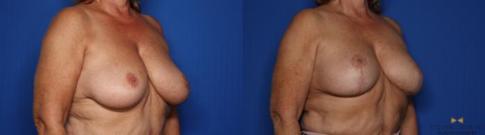 Before & After Breast Lift with or without Implants Case 411 Right Oblique View in Fort Worth, Texas