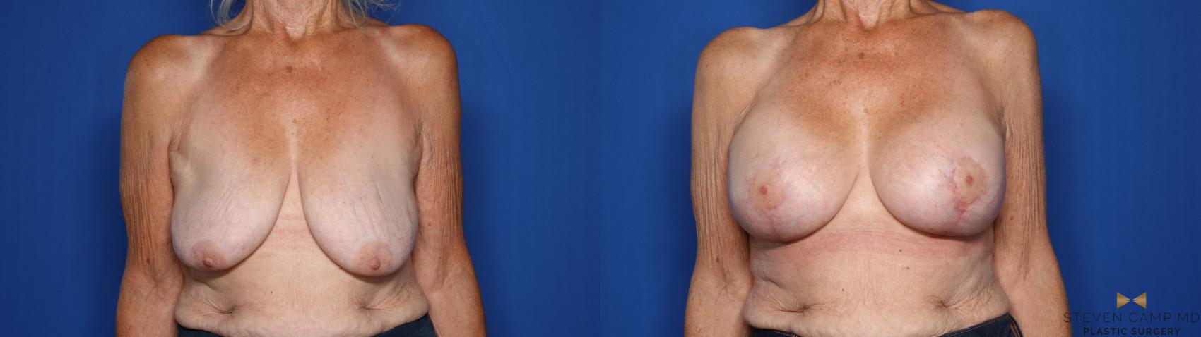 Before & After Breast Lift (Breast Mastopexy with Implants) Case 430 Front View in Fort Worth & Arlington, Texas