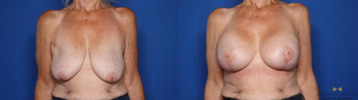 Before & After Breast Lift (Breast Mastopexy with Implants) Case 430 Front View in Fort Worth & Arlington, Texas