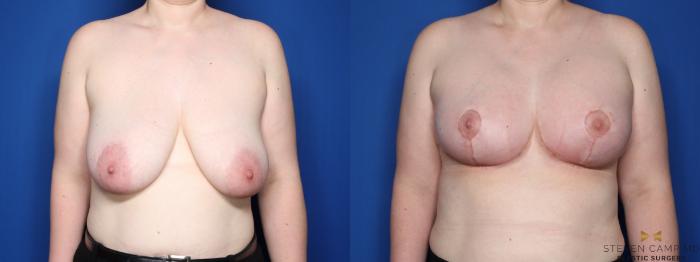 Before & After Breast Lift with or without Implants Case 441 Front View in Fort Worth, Texas