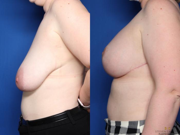 Before & After Breast Lift with or without Implants Case 441 Left Side View in Fort Worth, Texas
