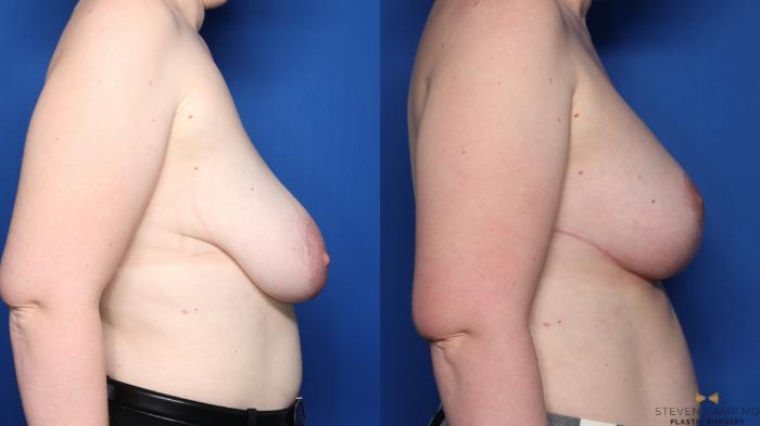Before & After Breast Lift with or without Implants Case 441 Right Side View in Fort Worth, Texas