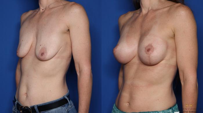 Before & After Breast Lift (Breast Mastopexy with Implants) Case 457 Left Oblique View in Fort Worth & Arlington, Texas