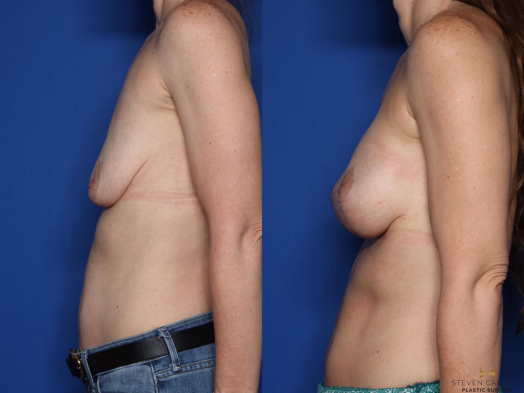 Before & After Breast Lift (Breast Mastopexy with Implants) Case 457 Left Side View in Fort Worth & Arlington, Texas