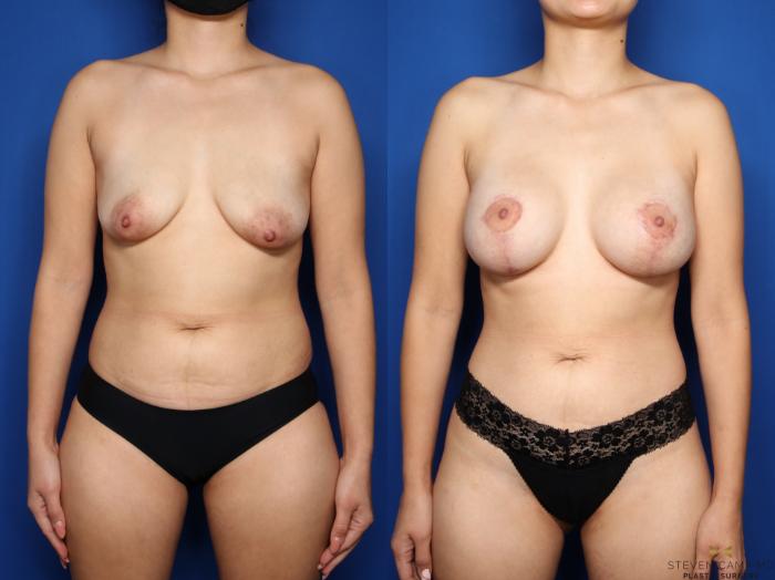 Before & After Breast Lift (Breast Mastopexy with Implants) Case 481 Front View in Fort Worth & Arlington, Texas