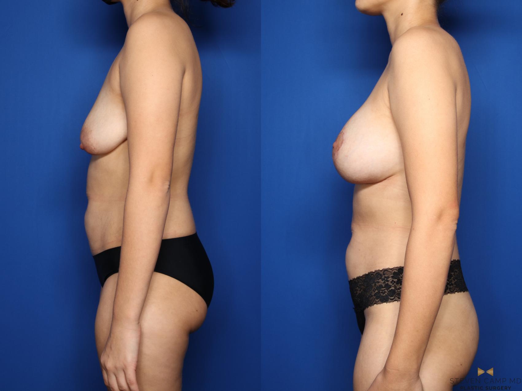 Before & After Breast Lift (Breast Mastopexy with Implants) Case 481 Left Side View in Fort Worth & Arlington, Texas
