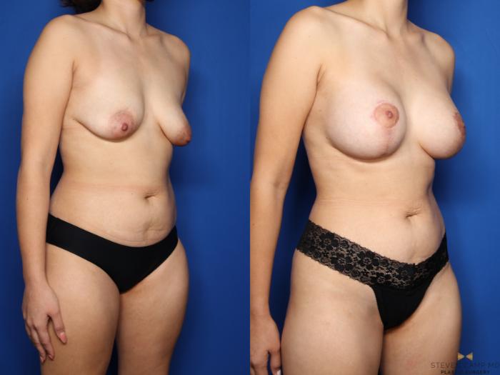 Before & After Breast Lift (Breast Mastopexy with Implants) Case 481 Right Oblique View in Fort Worth & Arlington, Texas
