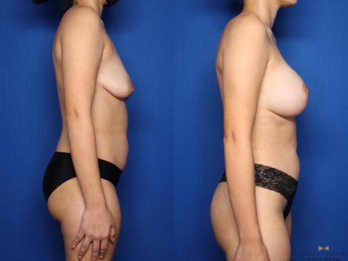 Before & After Breast Lift (Breast Mastopexy with Implants) Case 481 Right Side View in Fort Worth & Arlington, Texas