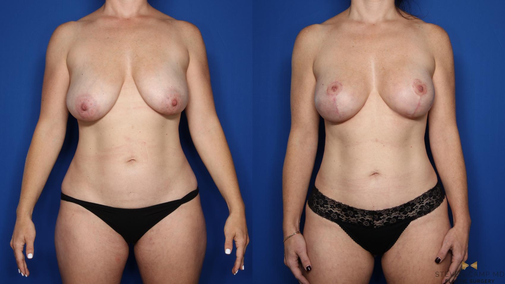Before & After Breast Lift (Breast Mastopexy with Implants) Case 551 Front View in Fort Worth & Arlington, Texas