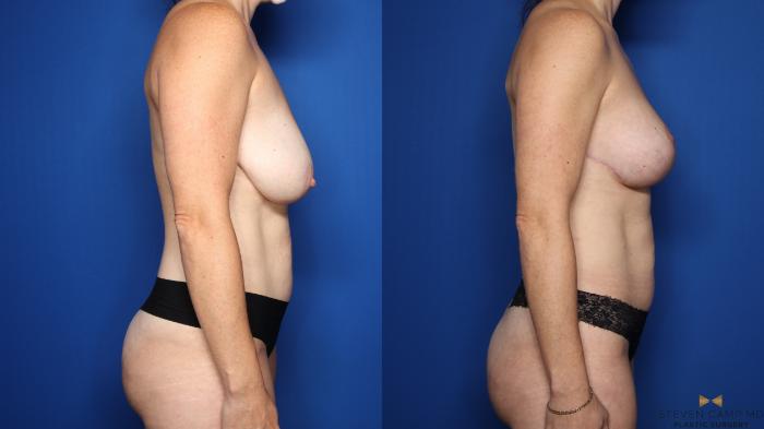 Before & After Breast Lift with or without Implants Case 551 Right Side View in Fort Worth, Texas