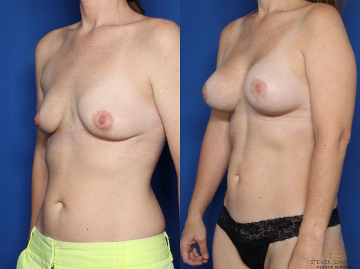 Before & After Breast Lift (Breast Mastopexy with Implants) Case 587 Left Oblique View in Fort Worth & Arlington, Texas