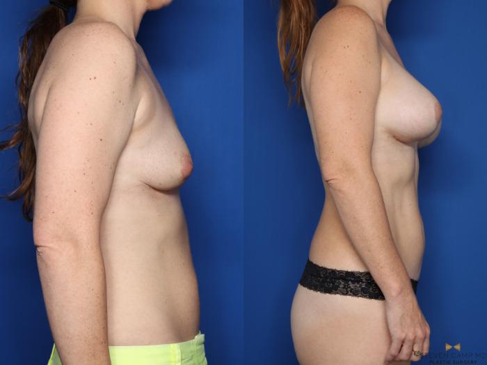 Before & After Breast Lift (Breast Mastopexy with Implants) Case 587 Right Side View in Fort Worth & Arlington, Texas